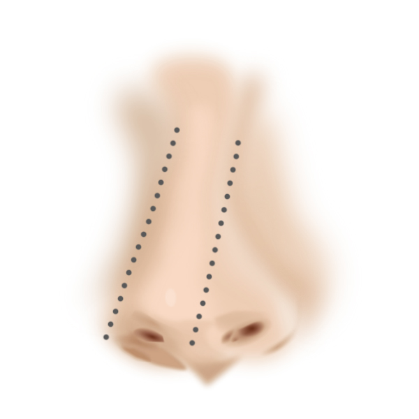 隆鼻重修-假體歪斜