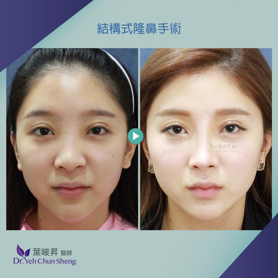 隆鼻手術case14-1