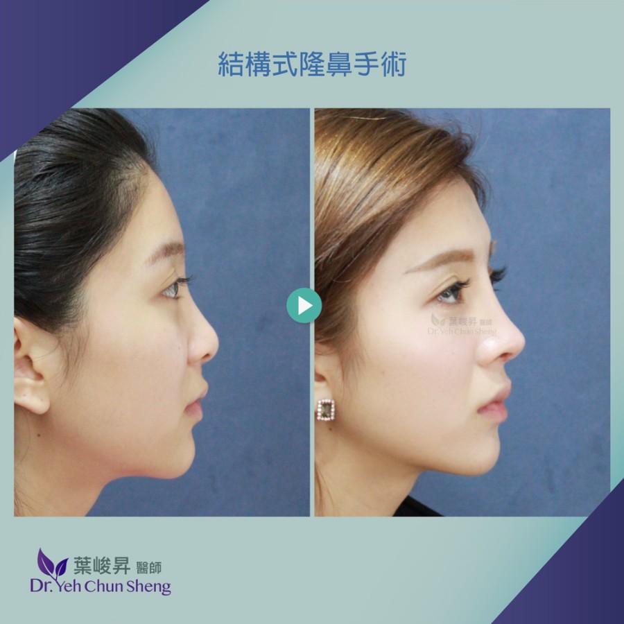隆鼻手術case14-3