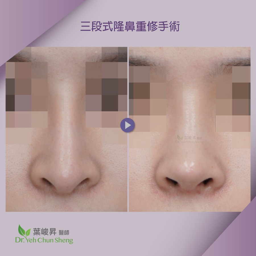 隆鼻手術case15-1