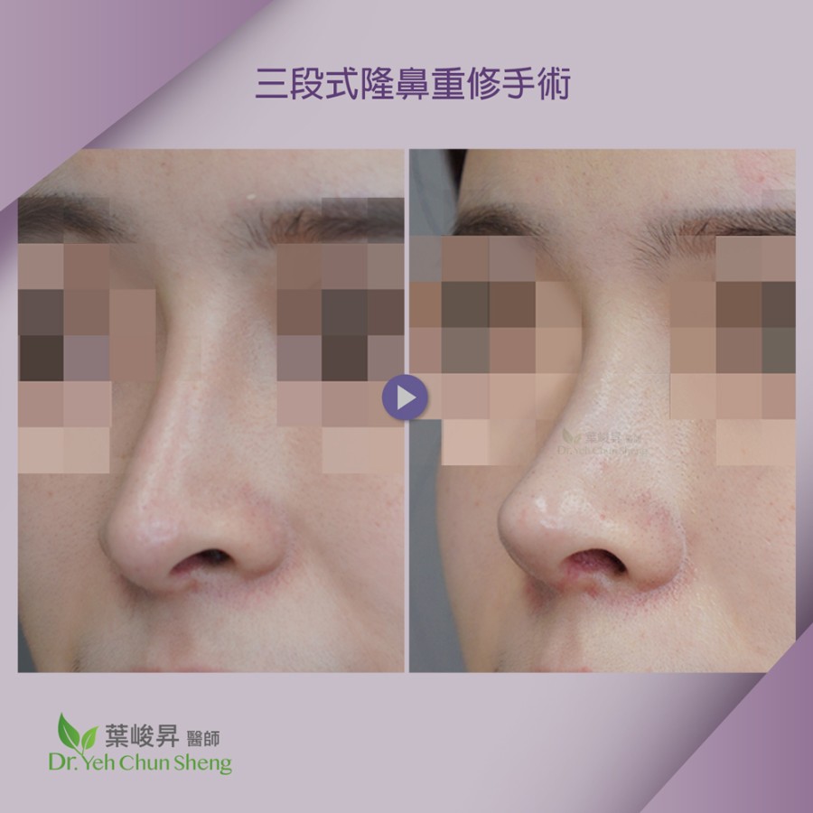 隆鼻手術case15-2