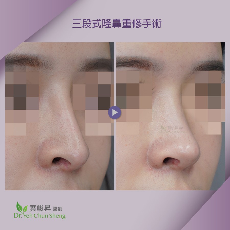 隆鼻手術case15-4