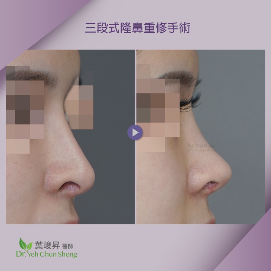 隆鼻手術case15-5