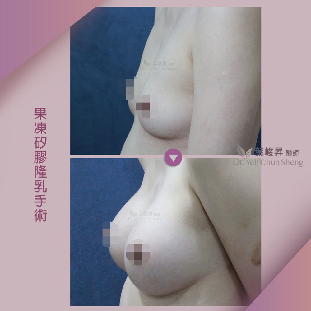 隆乳case01-2