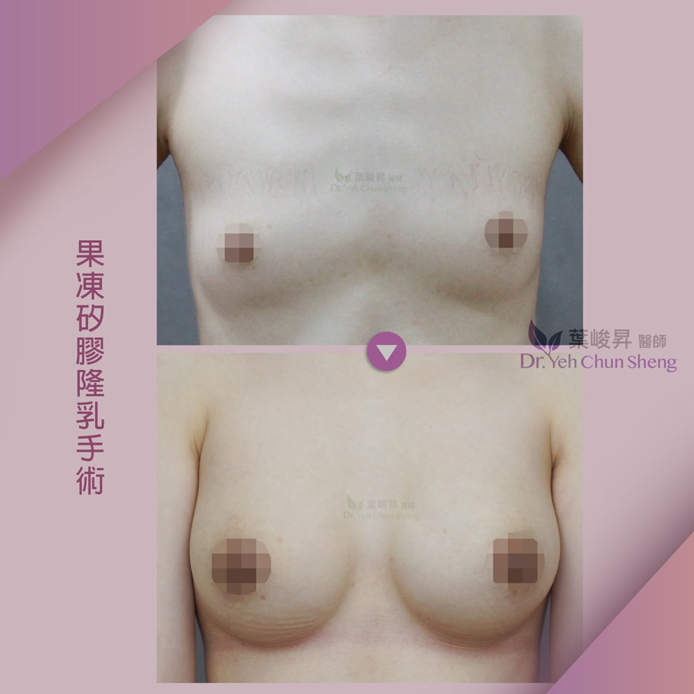 隆乳case02-1