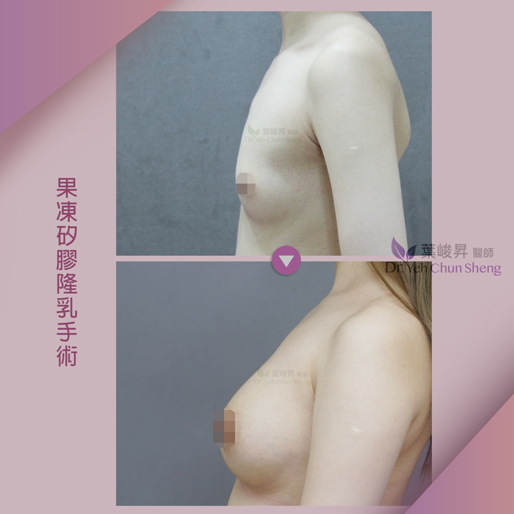 隆乳case02-3
