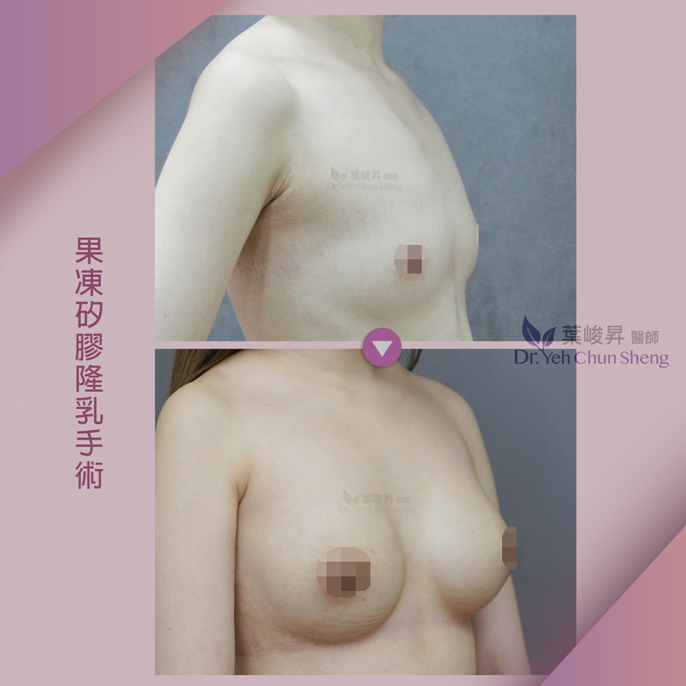 隆乳case02-4