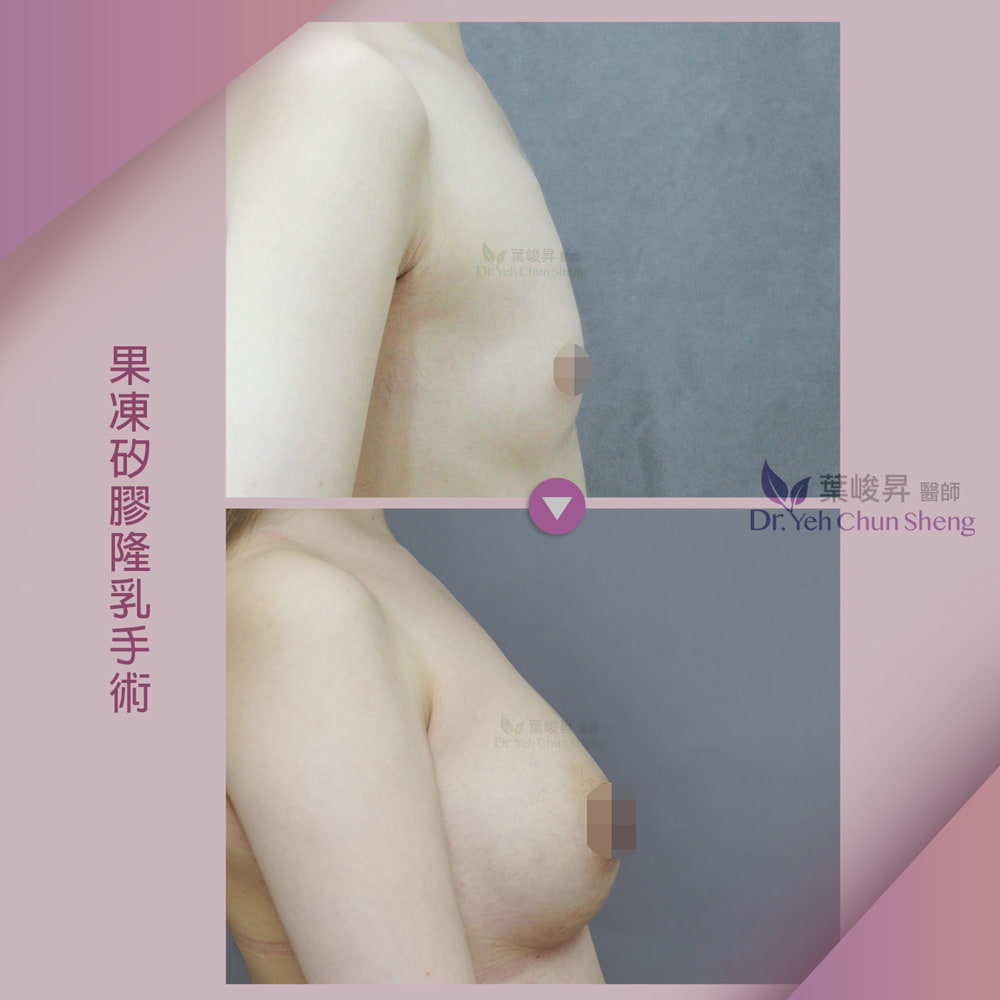 隆乳case02-5