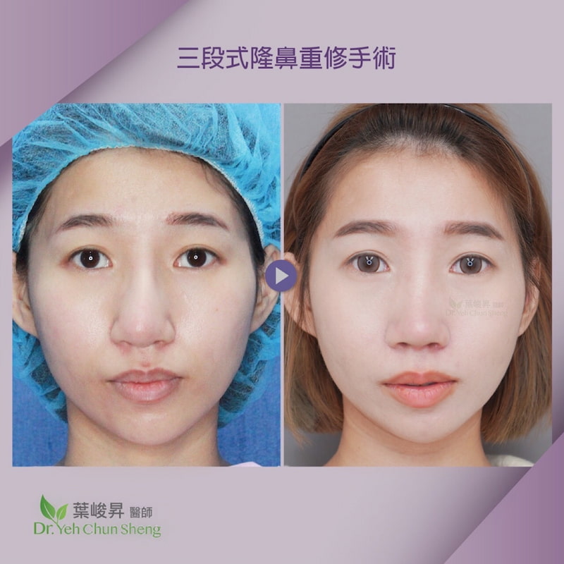 隆鼻手術case11-1