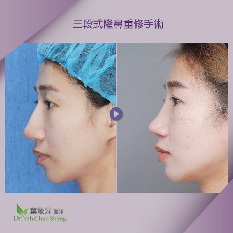 隆鼻手術case11-3