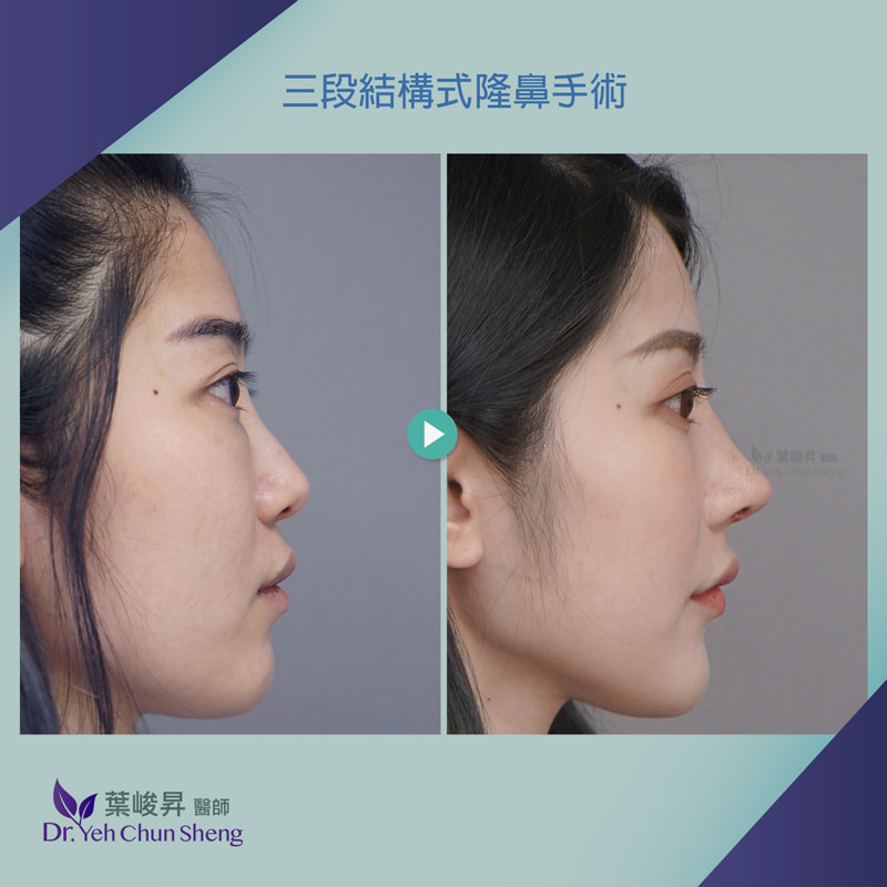 隆鼻手術case12-5
