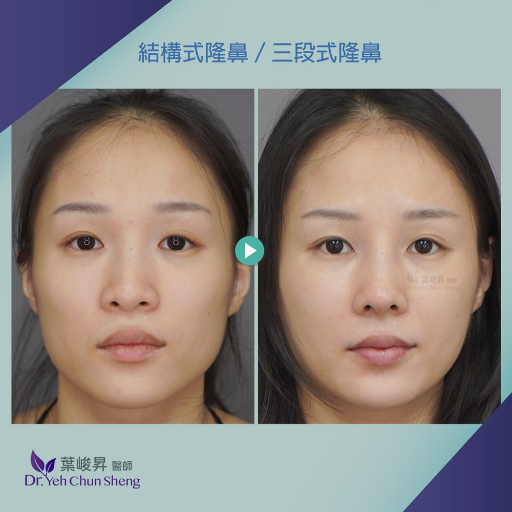 隆鼻手術case18-1